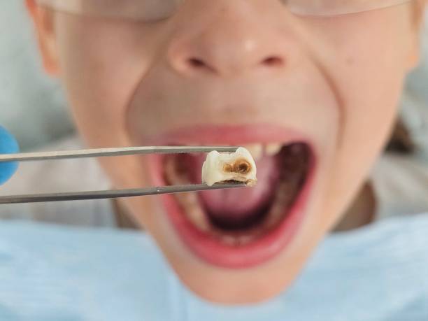 Best Urgent Care for Lost Fillings or Crowns in Chapel Hill, NC