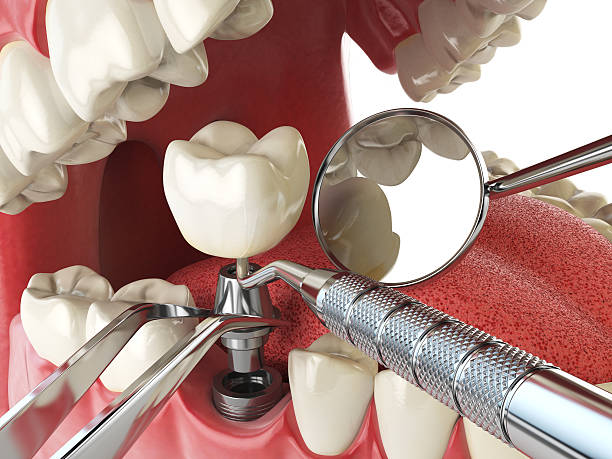 Best Emergency Tooth Extraction in Chapel Hill, NC